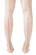 步态异常对儿童的影响插图3