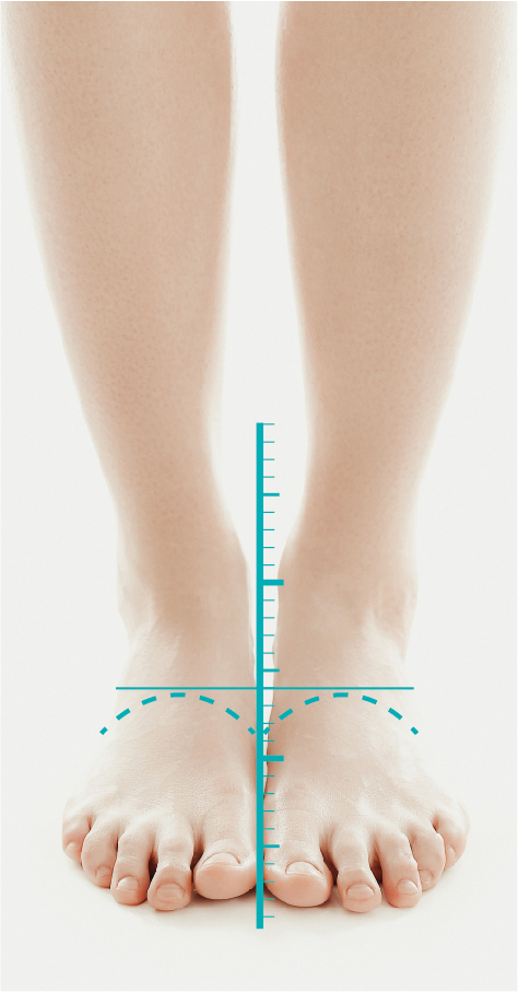 步态家庭自检插图