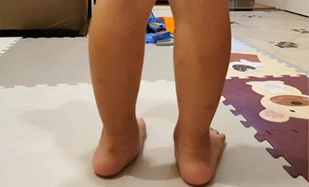 常见的儿童步态问题插图18