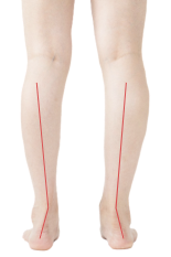 常见的儿童步态问题插图3