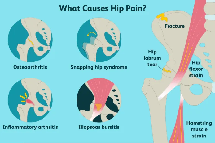 Causes of hip pain