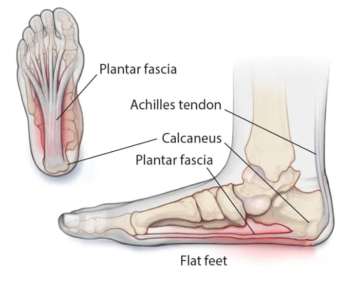 Plantar Fasciitis