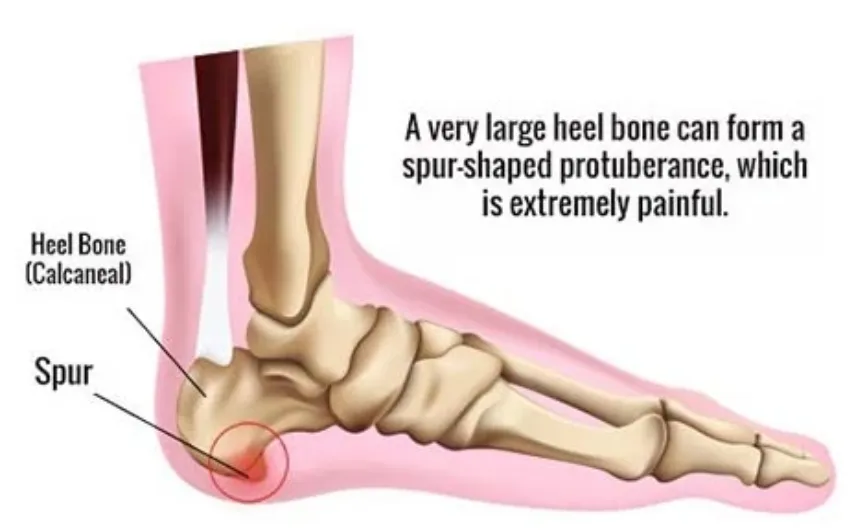 Heel Spurs