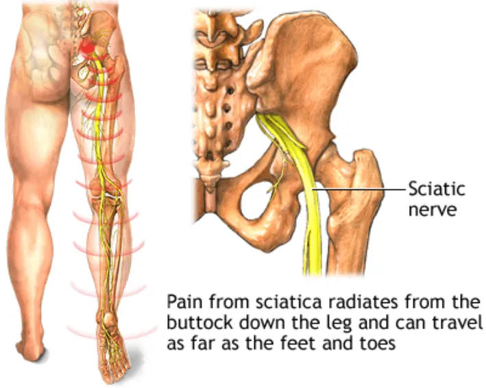 Sciatica