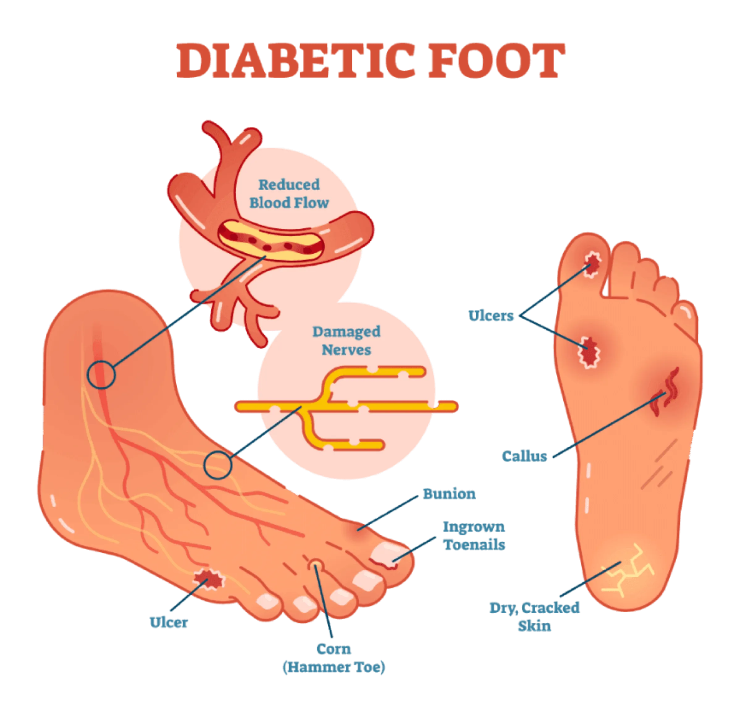 The Role of Foot Scanners in Diabetic Care