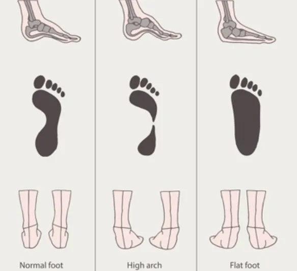 Flat feet vs high arches
