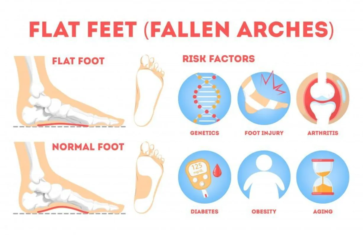Arch support insoles for flat feet